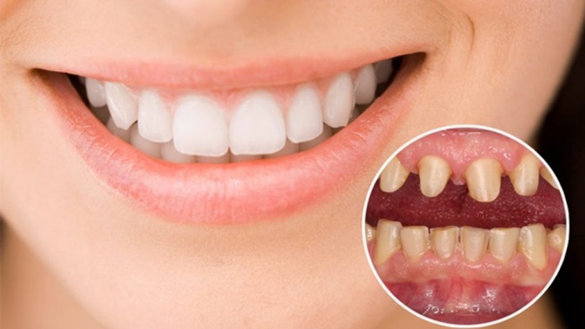 Bọc răng sứ Titan không cần mài cùi răng quá mỏng