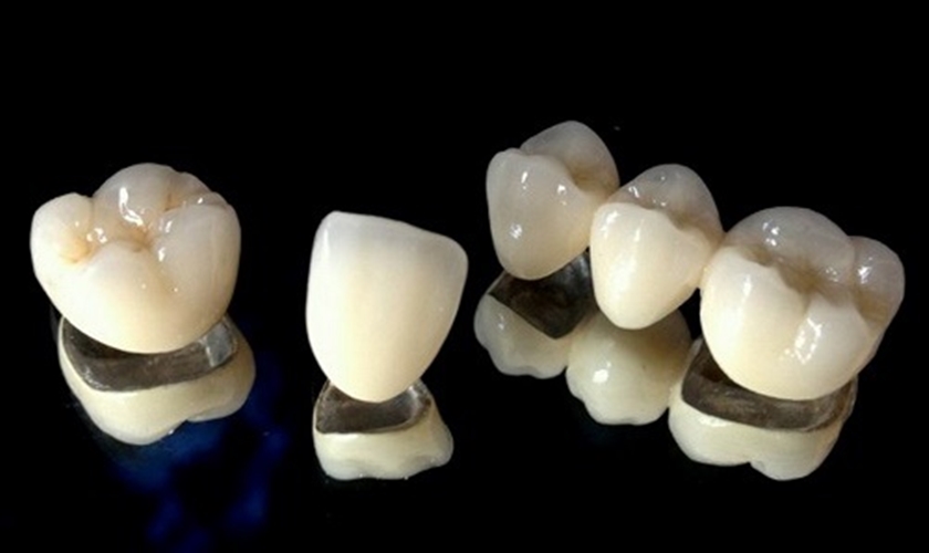 Có nhiều nguyên nhân dẫn đến tình trạng răng sứ Titan bị đen