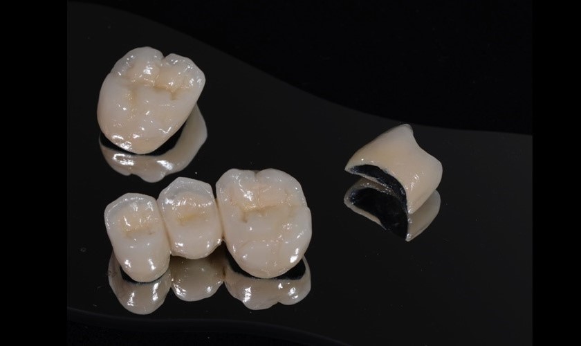 Thực hư giá làm răng sứ Titan có cao không? Chú ý gì sau khi làm răng sứ Titan?